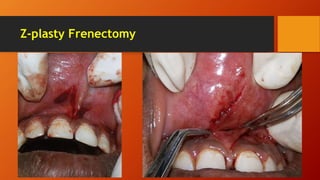 Z-plasty Frenectomy
 