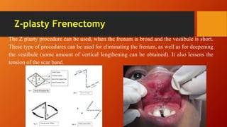 Z-plasty Frenectomy
The Z plasty procedure can be used, when the frenum is broad and the vestibule is short.
These type of procedures can be used for eliminating the frenum, as well as for deepening
the vestibule (some amount of vertical lengthening can be obtained). It also lessens the
tension of the scar band.
 