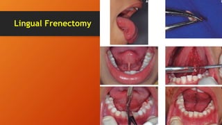 Lingual Frenectomy
 