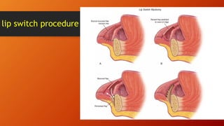 lip switch procedure
 
