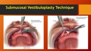 Submucosal Vestibuloplasty Technique
 