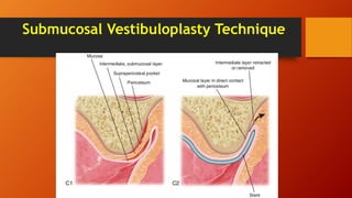 Submucosal Vestibuloplasty Technique
 