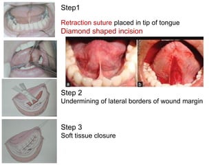 Undermining Incision Preprosthetic surgery.pdf