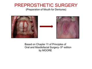 PREPROSTHETIC SURGERY
(Preparation of Mouth for Dentures)
Based on Chapter 11 of Principles of
Oral and Maxillofacial Surgery- 5th edition
by MOORE
 