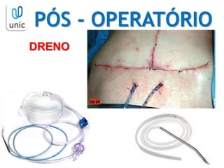 PÓS - OPERATÓRIO
DRENO
 