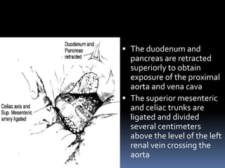  The duodenum and
pancreas are retracted
superiorly to obtain
exposure of the proximal
aorta and vena cava
 The superior mesenteric
and celiac trunks are
ligated and divided
several centimeters
above the level of the left
renal vein crossing the
aorta
 