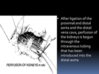  After ligation of the
proximal and distal
aorta and the distal
vena cava, perfusion of
the kidneys is begun
through the
intravenous tubing
that has been
introduced into the
distal aorta
 