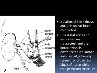  Isolation of the kidneys
and ureters has been
completed
 The distal aorta and
vena cava are
transected, and the
lumbar vessels
posteriorly are clamped
and divided, allowing
removal of the entire
block of tissue while
cold perfusion continues
 