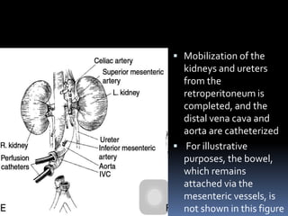  Mobilization of the
kidneys and ureters
from the
retroperitoneum is
completed, and the
distal vena cava and
aorta are catheterized
 For illustrative
purposes, the bowel,
which remains
attached via the
mesenteric vessels, is
not shown in this figure
 