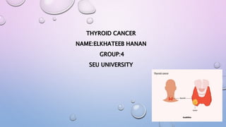 THYROID CANCER
NAME:ELKHATEEB HANAN
GROUP:4
SEU UNIVERSITY
 