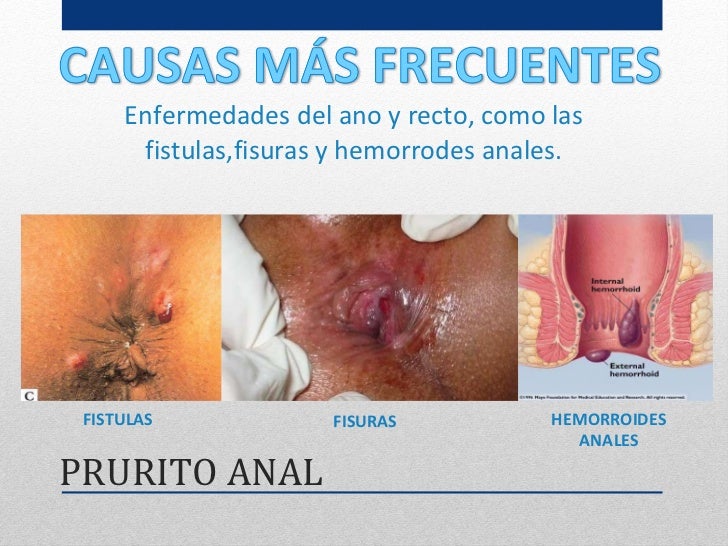 Por qué no es posible dar la sangre a la psoriasis