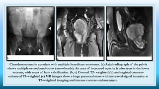 Chondrosarcoma in a patient with multiple hereditary exostoses. (a) Axial radiograph of the pelvis
shows multiple osteochondromas (arrowheads). An area of increased opacity is also seen in the lower
sacrum, with areas of faint calcification. (b, c) Coronal T2- weighted (b) and sagittal contrast-
enhanced T1-weighted (c) MR images show a large presacral mass with increased signal intensity at
T2-weighted imaging and intense contrast enhancement.
 