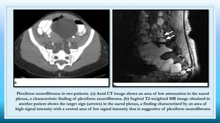 Plexiform neurofibroma in two patients. (a) Axial CT image shows an area of low attenuation in the sacral
plexus, a characteristic finding of plexiform neurofibroma. (b) Sagittal T2-weighted MR image obtained in
another patient shows the target sign (arrows) in the sacral plexus, a finding characterized by an area of
high signal intensity with a central area of low signal intensity that is suggestive of plexiform neurofibroma
 