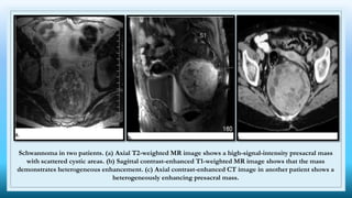 Schwannoma in two patients. (a) Axial T2-weighted MR image shows a high-signal-intensity presacral mass
with scattered cystic areas. (b) Sagittal contrast-enhanced T1-weighted MR image shows that the mass
demonstrates heterogeneous enhancement. (c) Axial contrast-enhanced CT image in another patient shows a
heterogeneously enhancing presacral mass.
 
