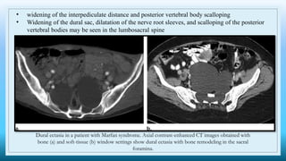 • widening of the interpediculate distance and posterior vertebral body scalloping
• Widening of the dural sac, dilatation of the nerve root sleeves, and scalloping of the posterior
vertebral bodies may be seen in the lumbosacral spine
Dural ectasia in a patient with Marfan syndrome. Axial contrast-enhanced CT images obtained with
bone (a) and soft-tissue (b) window settings show dural ectasia with bone remodeling in the sacral
foramina.
 