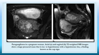 Paraganglioma in a pregnant woman. Axial (a) and sagittal (b) T2-weighted MR images
show a large presacral mass that is iso- to hyperintense with a hypointense rim, a finding
known as the cap sign.
 