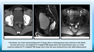 Chordoma. (a) Axial contrastenhanced CT image shows a homogeneous mass anterior to the distal
sacrum and coccyx. (b) Sagittal T2-weighted MR image shows the hyperintense mass. (c) Axial
contrast-enhanced T1-weighted MR image shows that the mass demonstrates only mild enhancement.
 