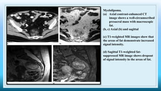 Myelolipoma.
(a) Axial contrast-enhanced CT
image shows a well-circumscribed
presacral mass with macroscopic
fat.
(b, c) Axial (b) and sagittal
(c) T1-weighted MR images show that
the areas of fat demonstrate increased
signal intensity.
(d) Sagittal T1-weighted fat-
suppressed MR image shows dropout
of signal intensity in the areas of fat.
 
