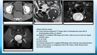 Solitary fibrous tumor.
(a) Axial contrast-enhanced CT image shows a homogeneous mass that is
isoattenuating relative to muscle.
(b) Sagittal T1-weighted MR image shows flow voids (arrows) in the low-signal-
intensity mass.
(c) (c, d) Axial
(c) and coronal
(d) contrast-enhanced T1-weighted MR images show that the mass demonstrates
intense enhancement. (e) Angiogram shows the tumor, which demonstrates
increased vascularity
 