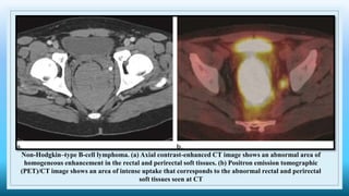Non-Hodgkin–type B-cell lymphoma. (a) Axial contrast-enhanced CT image shows an abnormal area of
homogeneous enhancement in the rectal and perirectal soft tissues. (b) Positron emission tomographic
(PET)/CT image shows an area of intense uptake that corresponds to the abnormal rectal and perirectal
soft tissues seen at CT
 