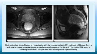 Gastrointestinal stromal tumor in two patients. (a) Axial contrast-enhanced T1-weighted MR image shows a
perirectal presacral mass that demonstrates intense enhancement. (b) Sagittal T2-weighted MR image in
another patient shows a larger mass with heterogeneous signal intensity.
 