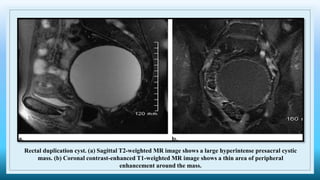 Rectal duplication cyst. (a) Sagittal T2-weighted MR image shows a large hyperintense presacral cystic
mass. (b) Coronal contrast-enhanced T1-weighted MR image shows a thin area of peripheral
enhancement around the mass.
 