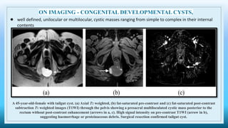 ON IMAGING - CONGENITAL DEVELOPMENTAL CYSTS,
● well defined, unilocular or multilocular, cystic masses ranging from simple to complex in their internal
contents
A 45-year-old-female with tailgut cyst. (a) Axial T2 weighted, (b) fat-saturated pre-contrast and (c) fat-saturated post-contrast
subtraction T1 weighted images (T1WI) through the pelvis showing a presacral multiloculated cystic mass posterior to the
rectum without post-contrast enhancement (arrows in a, c). High signal intensity on pre-contrast T1WI (arrow in b),
suggesting haemorrhage or proteinaceous debris. Surgical resection confirmed tailgut cyst.
 