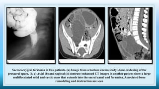 Sacrococcygeal teratoma in two patients. (a) Image from a barium enema study shows widening of the
presacral space. (b, c) Axial (b) and sagittal (c) contrast-enhanced CT images in another patient show a large
multiloculated solid and cystic mass that extends into the sacral canal and foramina. Associated bone
remodeling and destruction are seen
 