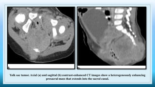 Yolk sac tumor. Axial (a) and sagittal (b) contrast-enhanced CT images show a heterogeneously enhancing
presacral mass that extends into the sacral canal.
 