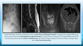 Giant cell tumor. (a) Lateral radiograph shows a lytic lesion involving S1 and S2. (b) Sagittal T2-weighted MR image
shows that the lesion has heterogeneous signal intensity. (c) Axial contrast-enhanced T1-weighted MR image shows
that the lesion demonstrates intense enhancement. (d) Axial CT image obtained with bone window settings clearly
shows lytic bone destruction.
 