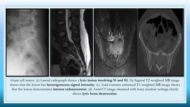 Sacral Classification Radiology pre sacral lesion sept5.pptx RADIOLOGY | PPTX | Bone and Joint ...
