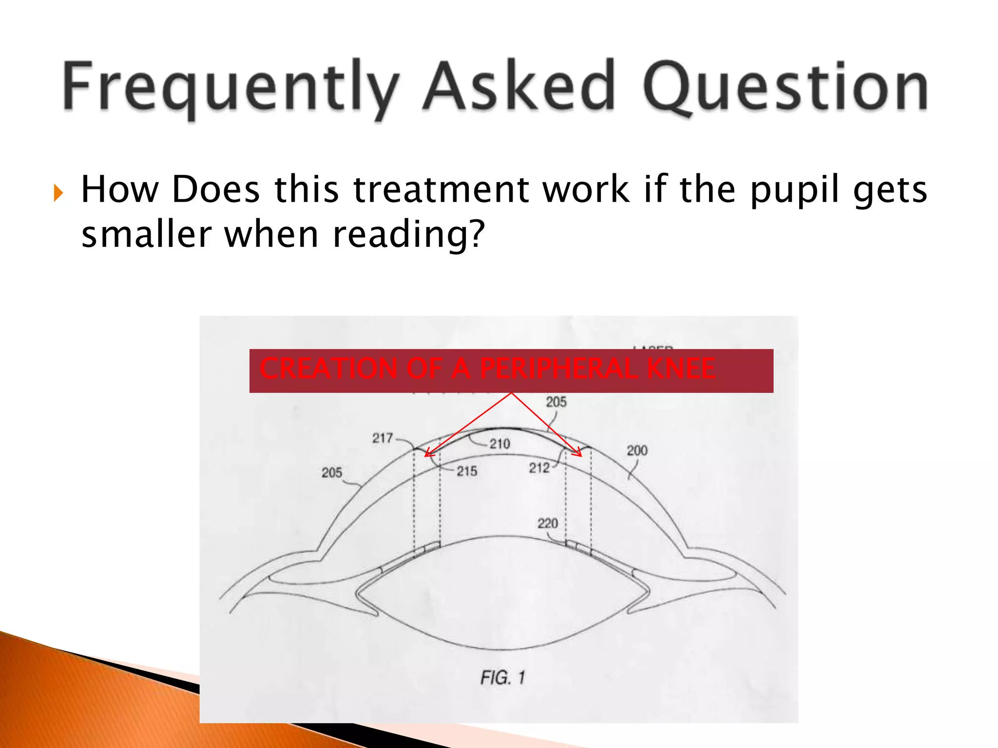 

How Does this treatment work if the pupil gets
smaller when reading?
CREATION OF A PERIPHERAL KNEE

 