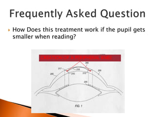 

How Does this treatment work if the pupil gets
smaller when reading?
CREATION OF A PERIPHERAL KNEE

 