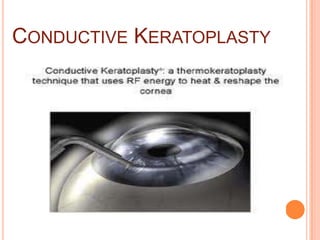 CONDUCTIVE KERATOPLASTY
 
