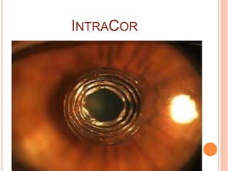 INTRACOR
 
