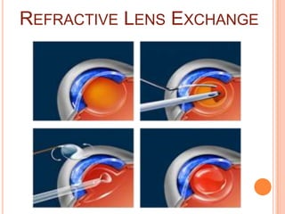 REFRACTIVE LENS EXCHANGE
 