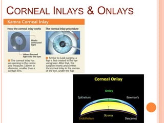 CORNEAL INLAYS & ONLAYS
 