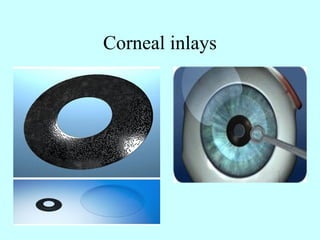 Corneal inlays
 