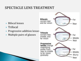  Bifocal lenses
 Trifocal
 Progressive addition lenses
 Multiple pairs of glasses
5/29/2017 18
 