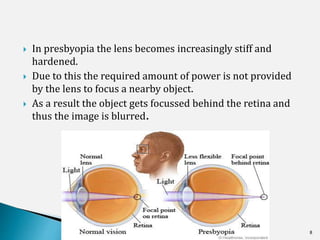  In presbyopia the lens becomes increasingly stiff and
hardened.
 Due to this the required amount of power is not provided
by the lens to focus a nearby object.
 As a result the object gets focussed behind the retina and
thus the image is blurred.
5/29/2017 8
 