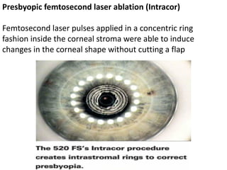 Presbyopic femtosecond laser ablation (Intracor)
Femtosecond laser pulses applied in a concentric ring
fashion inside the corneal stroma were able to induce
changes in the corneal shape without cutting a flap
 