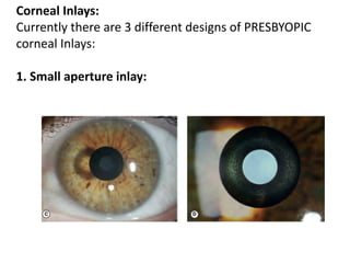 Corneal Inlays:
Currently there are 3 different designs of PRESBYOPIC
corneal Inlays:
1. Small aperture inlay:
 