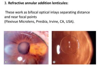 3. Refractive annular addition lenticules:
These work as bifocal optical inlays separating distance
and near focal points
(Flexivue Microlens, Presbia, Irvine, CA, USA).
 