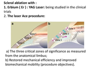 Scleral ablation with :
1. Erbium ( Er ) : YAG Laser: being studied in the clinical
trials
2. The laser Ace procedure:
a) The three critical zones of significance as measured
from the anatomical limbus;
b) Restored mechanical efficiency and improved
biomechanical mobility (procedure objectives).
 