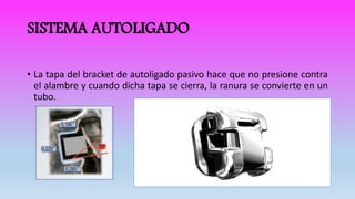 SISTEMA AUTOLIGADO
• La tapa del bracket de autoligado pasivo hace que no presione contra
el alambre y cuando dicha tapa se cierra, la ranura se convierte en un
tubo.
 