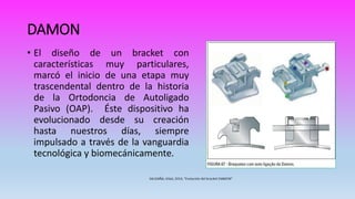 DAMON
• El diseño de un bracket con
características muy particulares,
marcó el inicio de una etapa muy
trascendental dentro de la historia
de la Ortodoncia de Autoligado
Pasivo (OAP). Éste dispositivo ha
evolucionado desde su creación
hasta nuestros días, siempre
impulsado a través de la vanguardia
tecnológica y biomecánicamente.
 