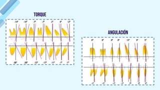 Torque
Angulación
 