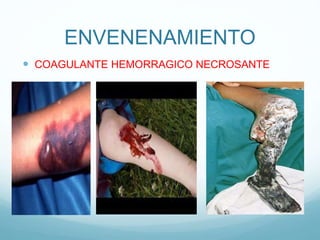 ENVENENAMIENTO
 COAGULANTE HEMORRAGICO NECROSANTE
 