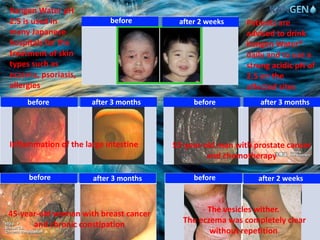 52-year-old man with prostate cancer
and chemotherapy
Inflammation of the large intestine
45-year-old woman with breast cancer
and chronic constipation
The vesicles wither.
The eczema was completely clear
without repetition
Kangen Water pH
2.5 is used in
many Japanese
hospitals for the
treatment of skin
types such as
eczema, psoriasis,
allergies
Patients are
advised to drink
Kangen Water®
daily and to use a
strong acidic pH of
2.5 on the
affected sites
before
before before
before before
after 3 months after 3 months
after 3 months after 2 weeks
after 2 weeks
 