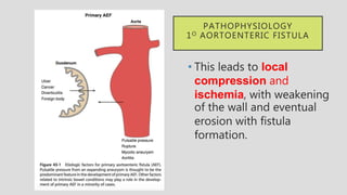 • This leads to local
compression and
ischemia, with weakening
of the wall and eventual
erosion with fistula
formation.
PATHOPHYSIOLOGY
1O AORTOENTERIC FISTULA
 
